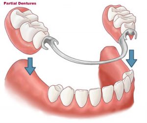 dentures-partial1